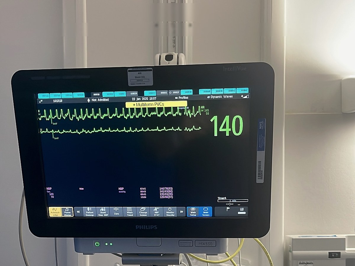 A hospital monitor showing a fast heart rhythm trace.